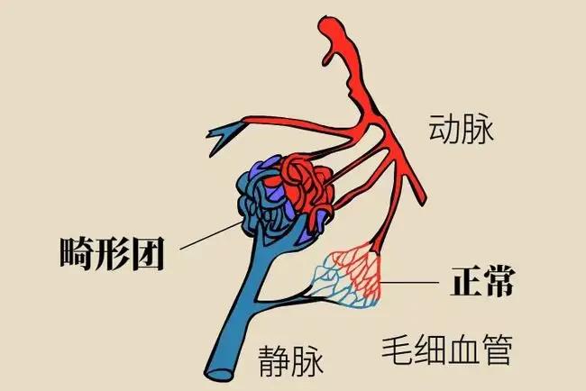 先天性脑血管疾病是导致脑出血的重要原因,如脑动脉瘤,脑动静脉畸形等