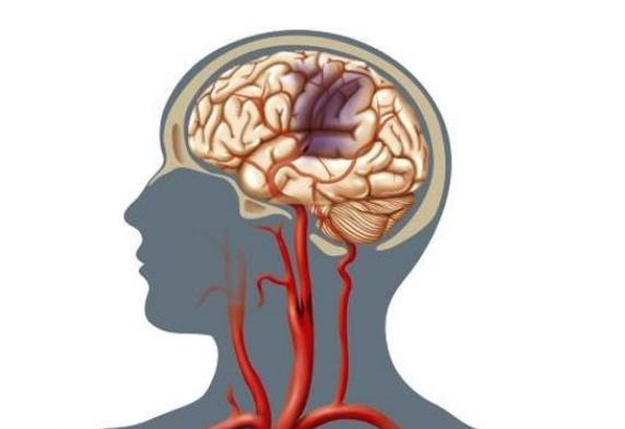 识别脑血栓早期症状 尽量减少残疾发生